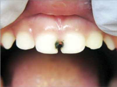 Featured Image For Silver Diamine Fluoride (SDF) Can it Help My Child’s Teeth?