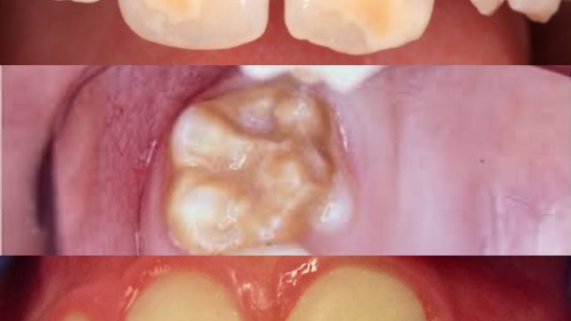 Featured Image For What’s this spot on my tooth? – Enamel Hypoplasia or Hypomineralization