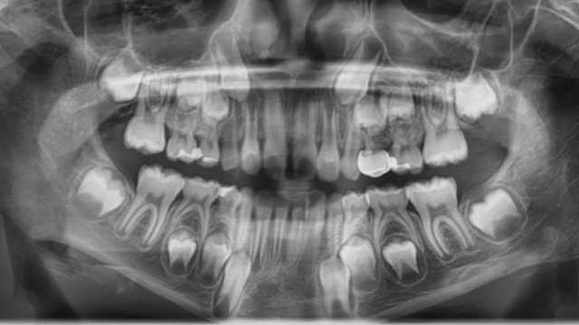 Featured Image For Panoramic Xrays & Missing/Extra Teeth